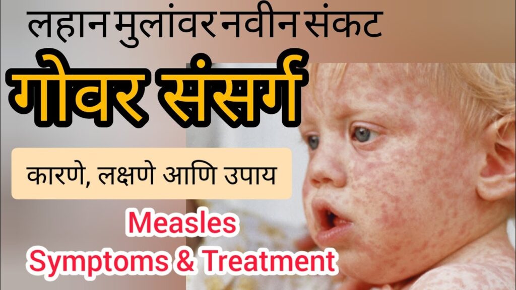 Measles in Children