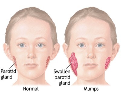 Mumps signs